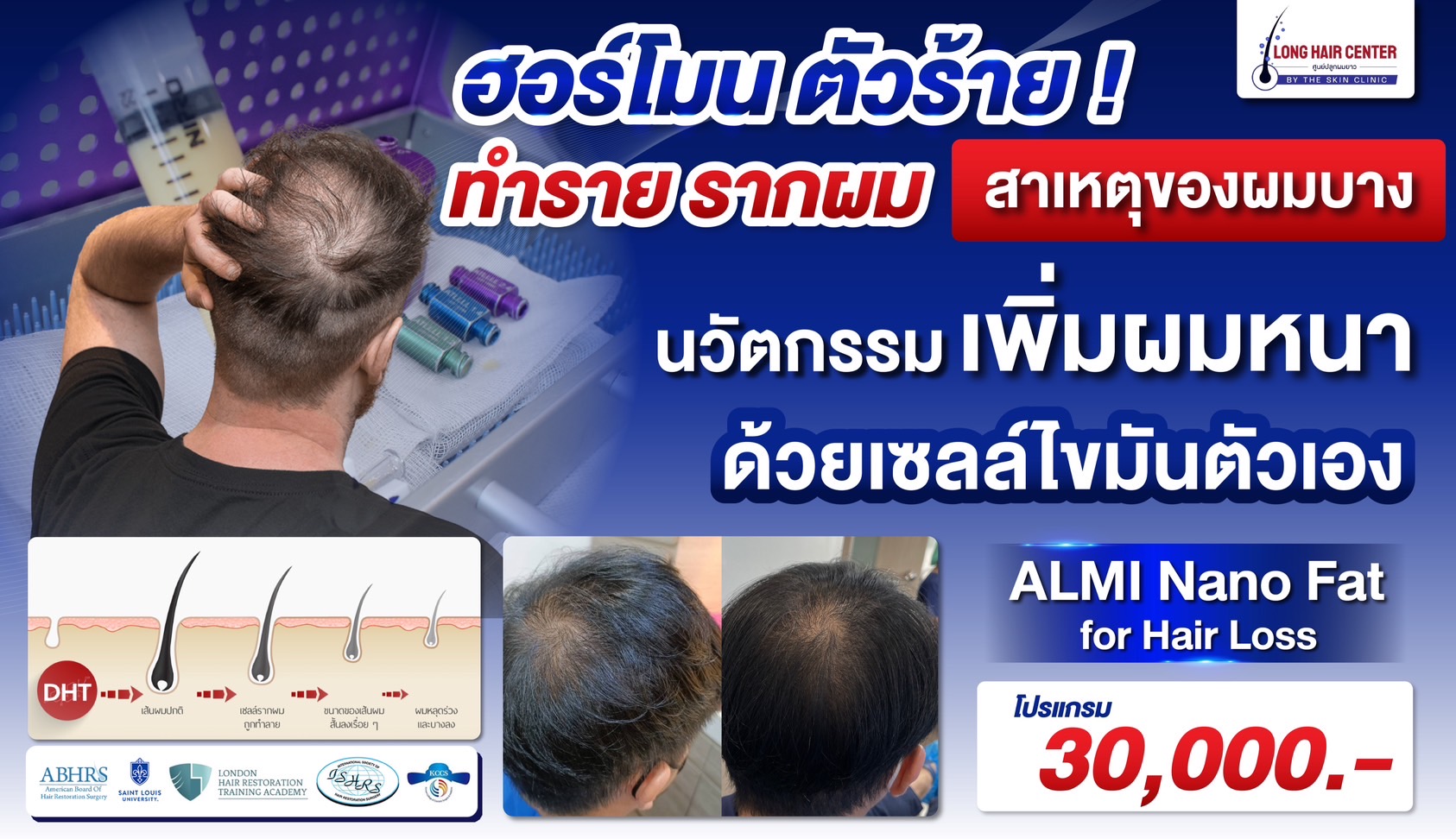 ALMI Nano Fat กระตุ้นรากผมด้วยไขมัน